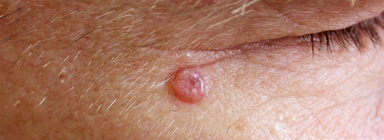 Best Basal Cell Cancer Treatment in Altrincham, UK