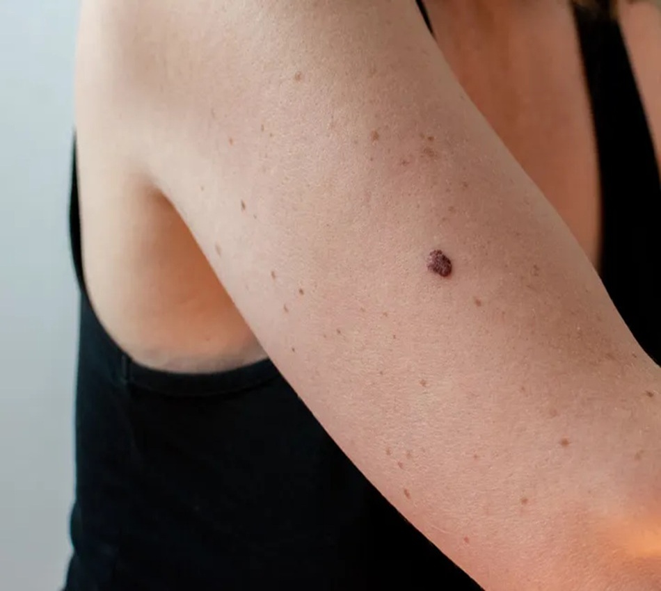 Basal Cell Carcinoma treatment Altrincham, BCC removal UK, skin cancer treatment Altrincham, Mohs surgery clinic Cheshire, Bollin Clinic dermatology, skin lesion removal experts UK