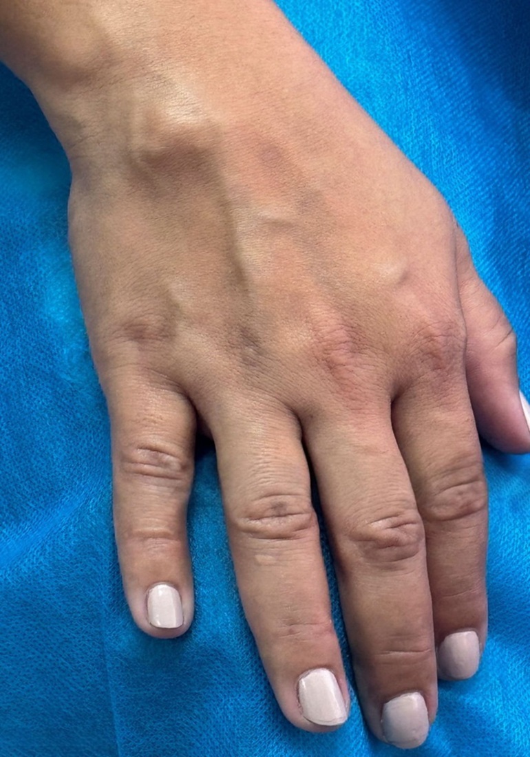 Best Cyst Treatment in Altrincham, UK