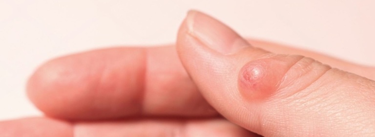 Best Cyst and Mucous Cyst Treatment in Altrincham, UK