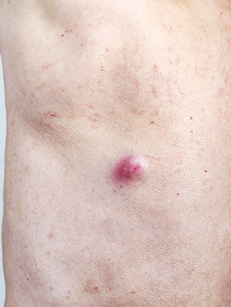 Best Cysts Treatment in Altrincham, UK