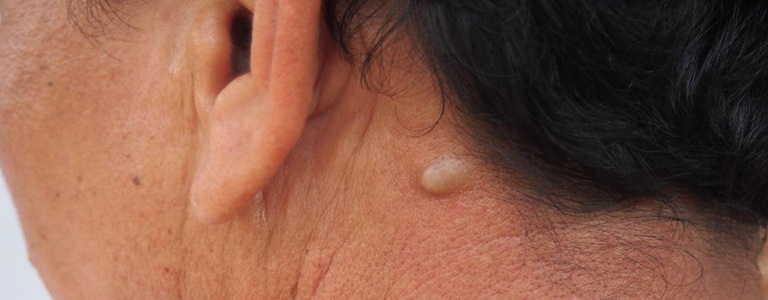 Best Cysts Treatment in Altrincham, UK