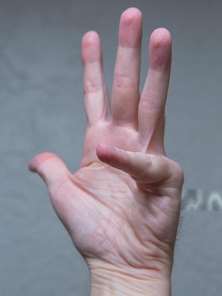 Best Dupuytren's Contracture Treatment in Altrincham, UK