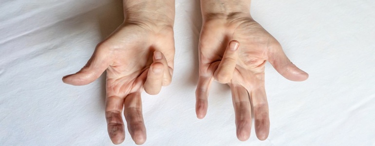 Best Dupuytren's Contracture Treatment in Altrincham, UK