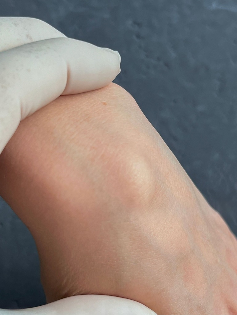 Best Ganglion Cyst Treatment in Altrincham, UK