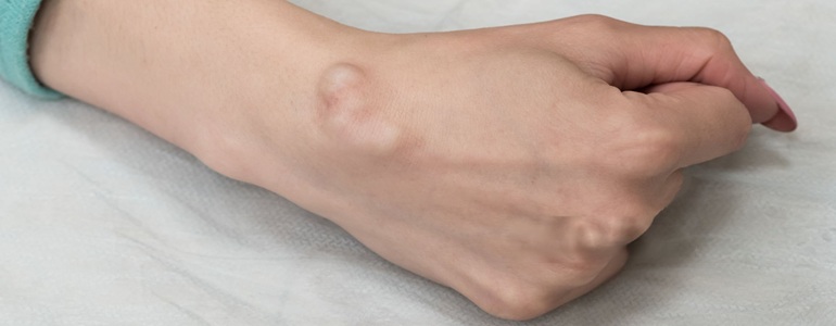 Best Ganglion Cyst Treatment in Altrincham, UK