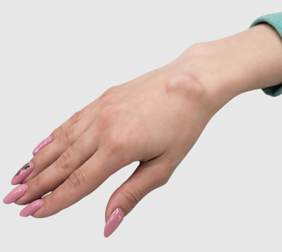 Ganglion cyst treatment Altrincham, Bollin Clinic, wrist cyst removal, hand cyst treatment UK, minimally invasive cyst surgery