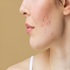 Acne treatment at Bollin Clinic