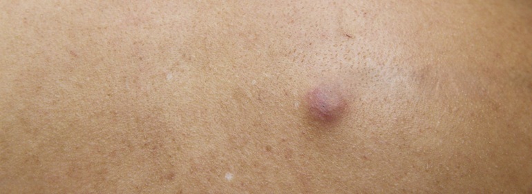 Best Lipoma Treatment in Altrincham, UK