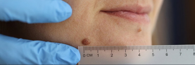 Best Moles and Skin Blemishes Treatment in Altrincham, UK