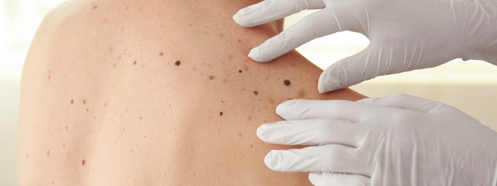 Best HydraFacial Treatment in Altrincham, UK