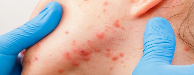 Expert Skin Lesions Treatment in Altrincham, UK