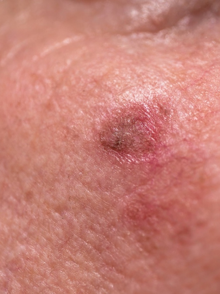 Expert Squamous Cell Cancer Treatment in Altrincham, UK
