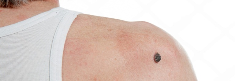 Expert Squamous Cell Cancer Treatment in Altrincham, UK