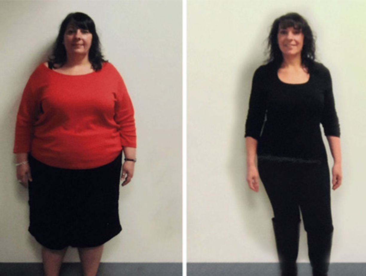 Weight Loss Surgery Altrincham, Bollin Clinic bariatric surgery UK, gastric bypass, gastric sleeve, sustainable weight loss, before and after results UK