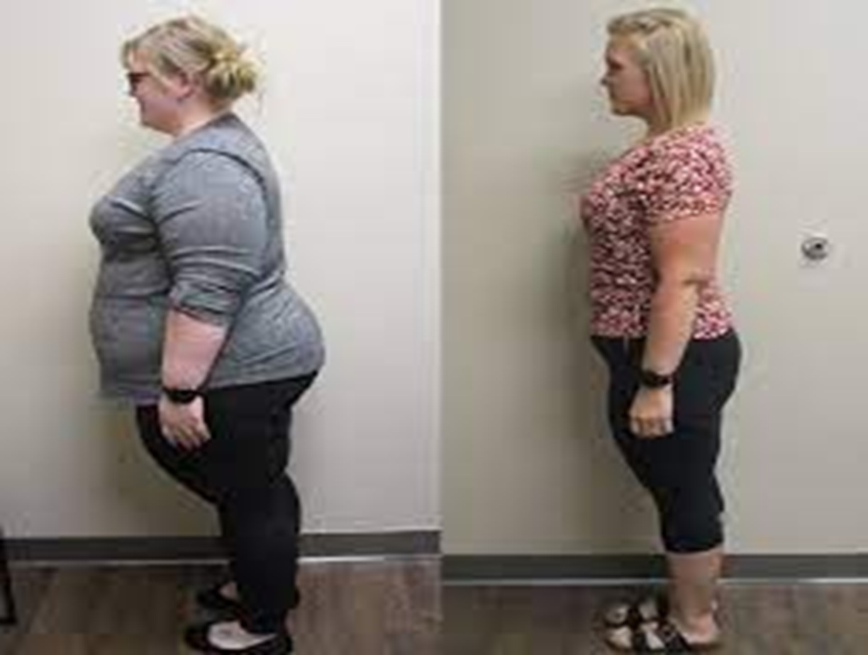 Weight Loss Surgery Altrincham, Bollin Clinic bariatric surgery UK, gastric bypass, gastric sleeve, before and after transformation, post-weight loss results UK