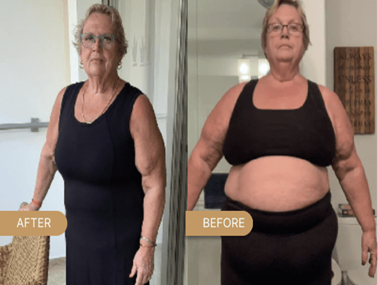 Weight Loss Surgery Altrincham, Bollin Clinic bariatric surgery UK, post-surgery transformation, gastric bypass before and after, successful weight loss results UK