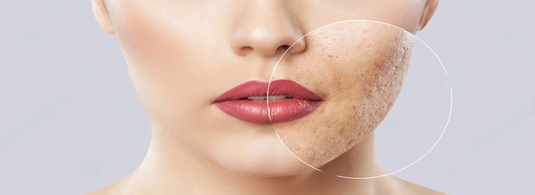 Acne Scar Treatment at Bollin Clinic