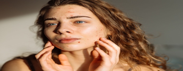 Acne Treatment At Bollin Clinic