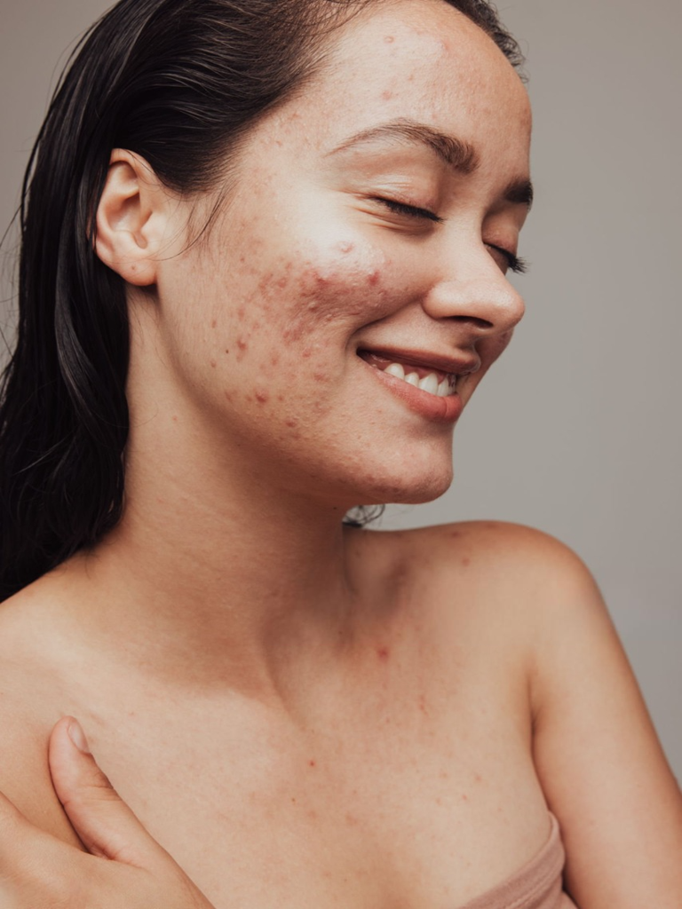 Acne treatment at Bollin Clinic