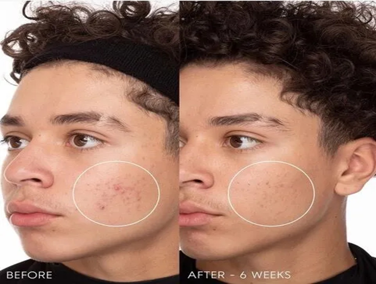 DermaQuest Altrincham, DermaQuest Before and After, Acne treatment Altrincham, Skin rejuvenation, Anti-aging facial, DermaQuest results
