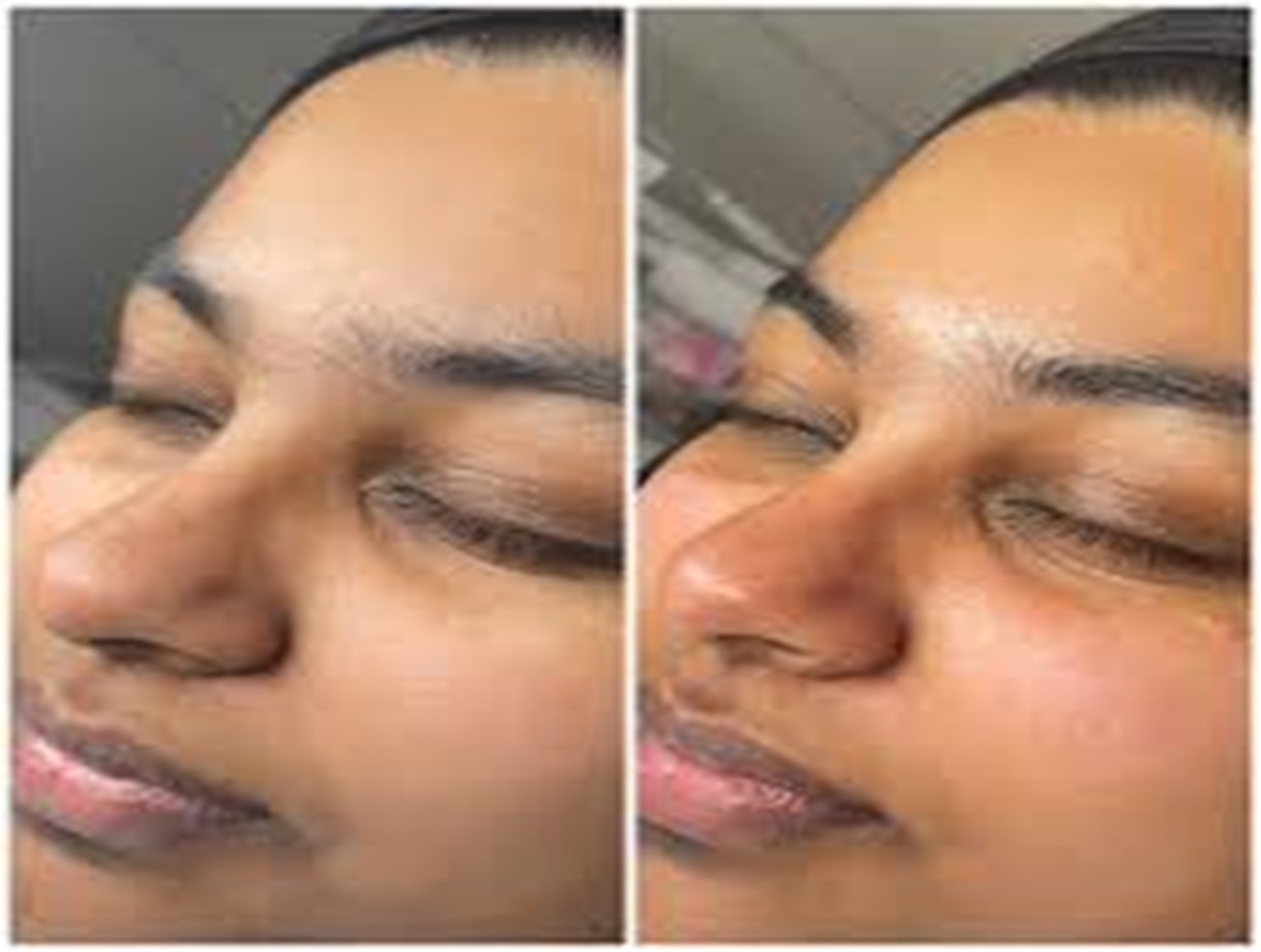 DermaQuest Altrincham, DermaQuest Before and After, Acne treatment Altrincham, Skin rejuvenation, Anti-aging facial, DermaQuest results