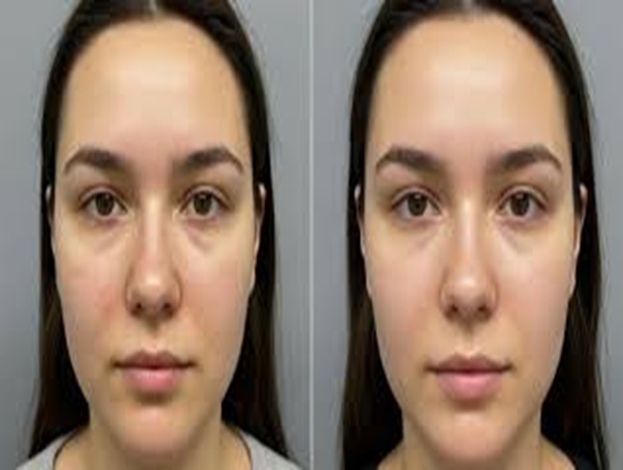 DermaQuest Altrincham, DermaQuest Before and After, Acne treatment Altrincham, Skin rejuvenation, Anti-aging facial, DermaQuest results