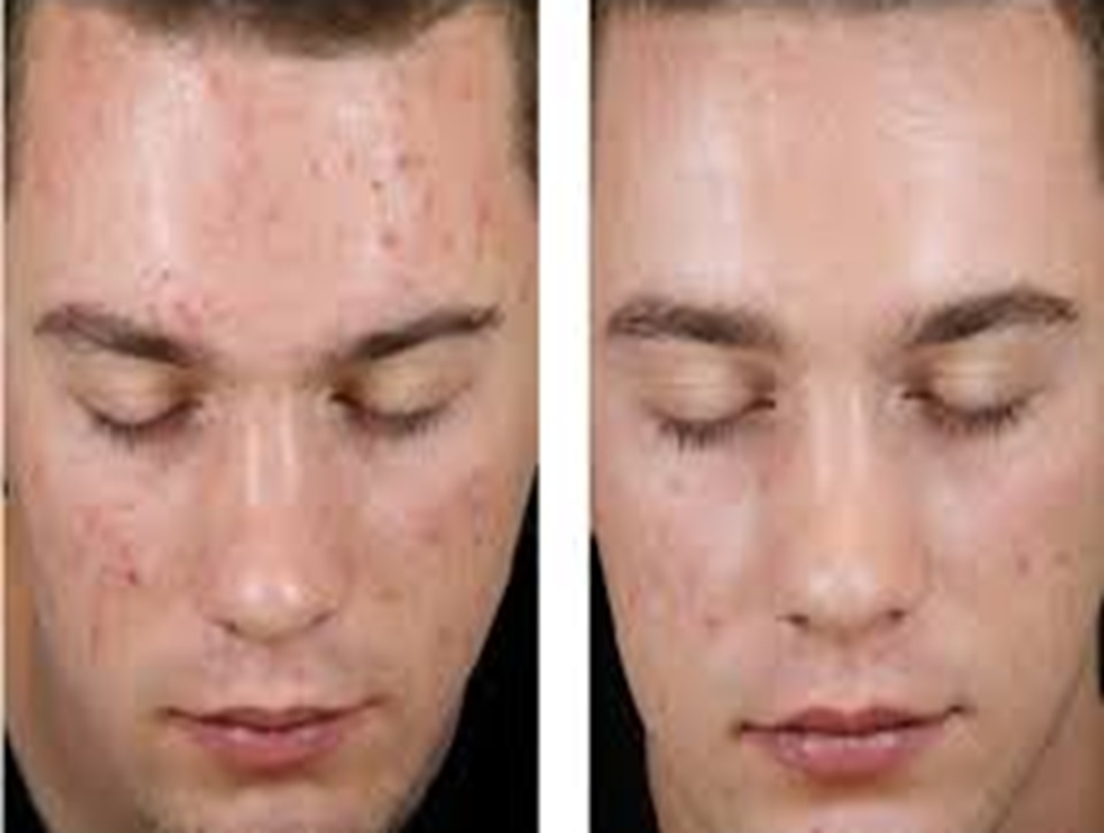 DermaQuest Altrincham, DermaQuest Before and After, Acne treatment Altrincham, Skin rejuvenation, Anti-aging facial, DermaQuest results
