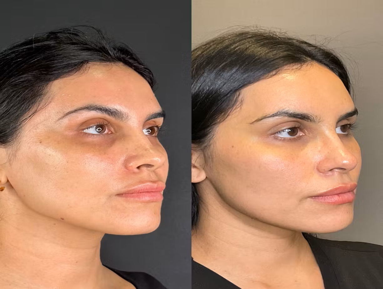 HydraFacial Before and After Altrincham, Bollin Clinic, skin glow, hydration treatment, non-invasive facial, clearer skin, smoother texture, improved skin tone