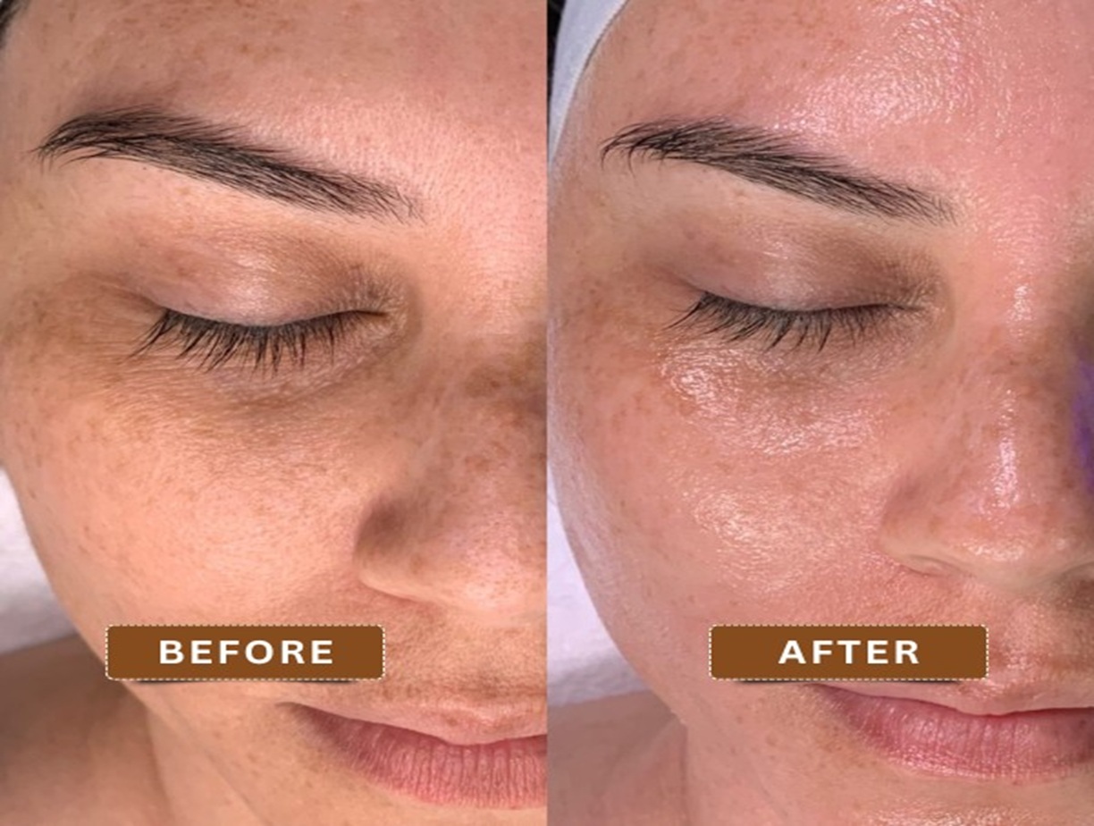 HydraFacial Before and After Altrincham, Bollin Clinic, brighter skin, anti-aging facial, clean pores, reduced wrinkles, smooth skin results