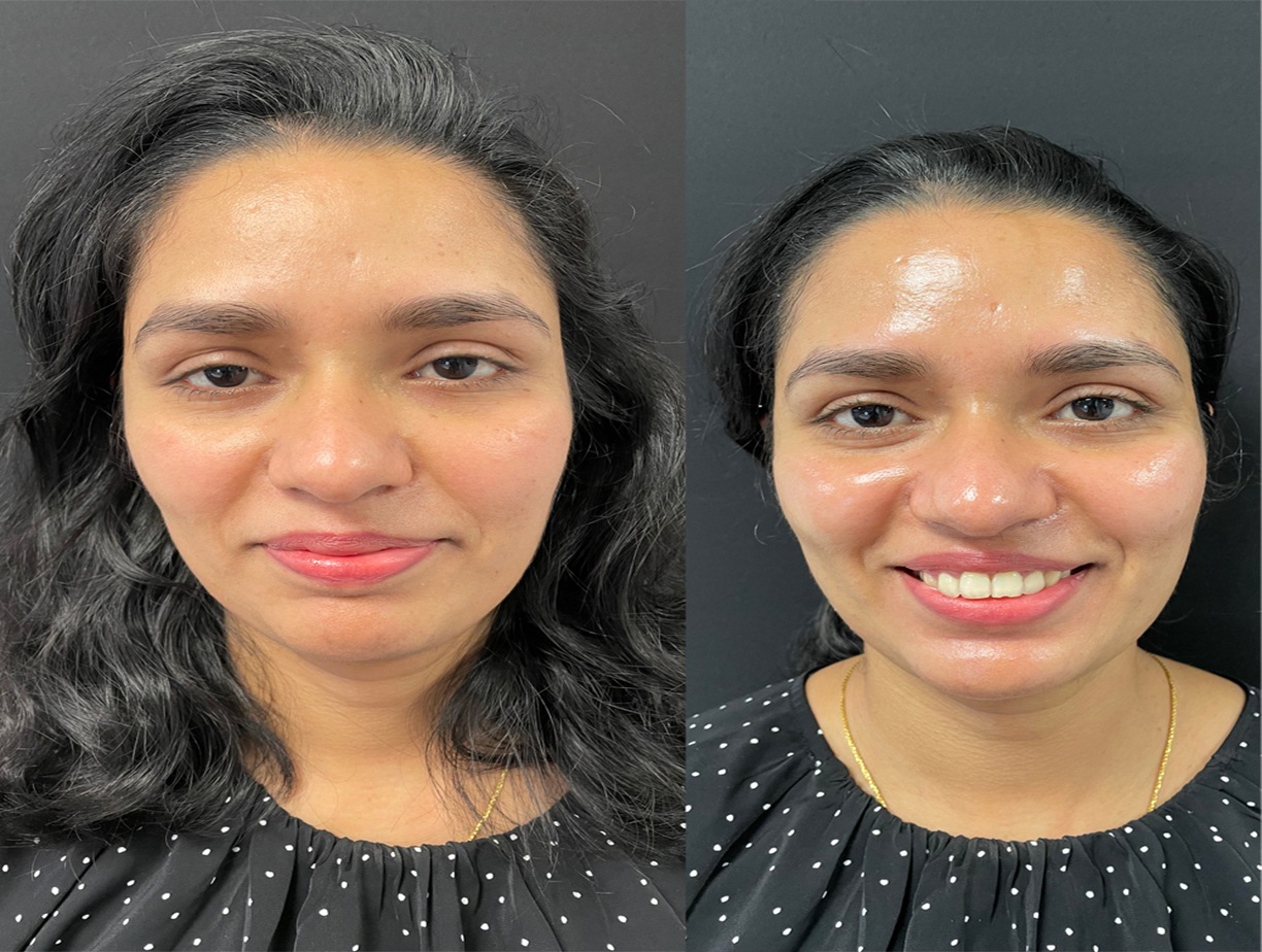 HydraFacial Before and After Altrincham, Bollin Clinic, skin rejuvenation treatment, acne facial, glowing skin transformation