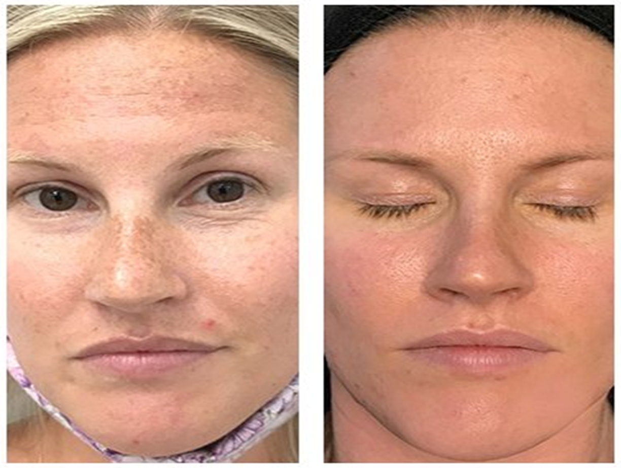 HydraFacial Before and After Altrincham, Bollin Clinic, skin rejuvenation treatment, acne facial, glowing skin transformation