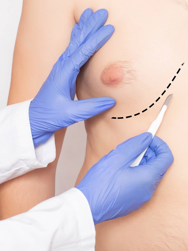 Best Gynecomastia Surgery in Altrincham