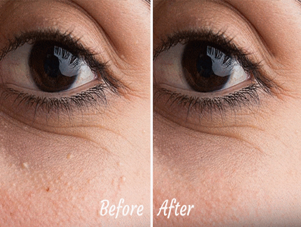 Milia removal Altrincham, Bollin Clinic skin treatments, before and after milia extraction