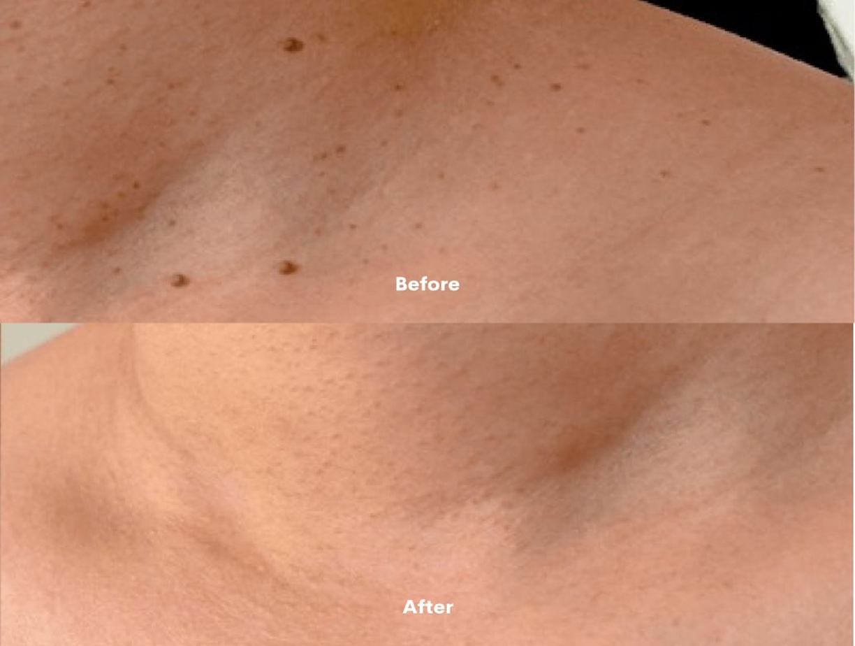 Bollin Clinic Altrincham, facial milia removal results, skin improvement treatment