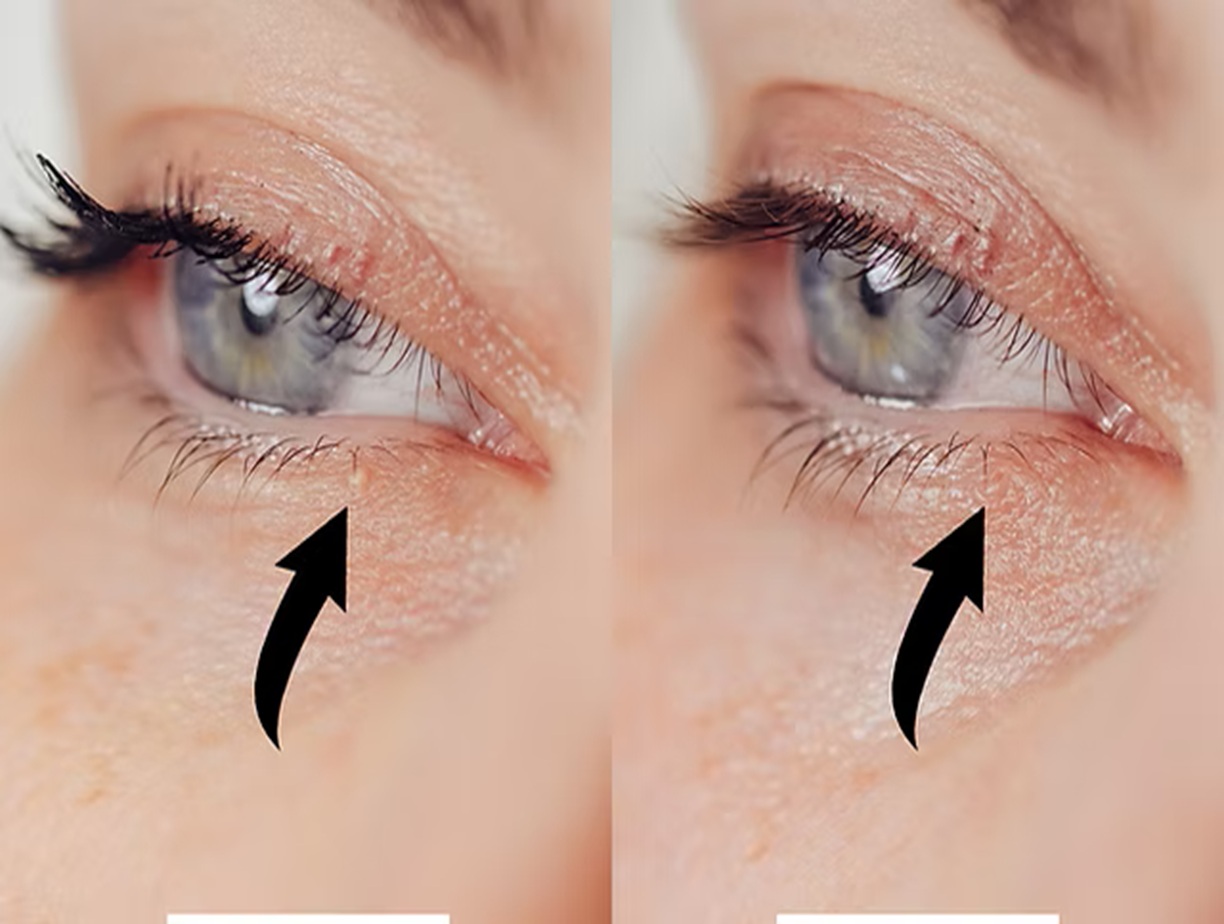 Before and after milia removal, Altrincham cosmetic skin clinic, Bollin Clinic