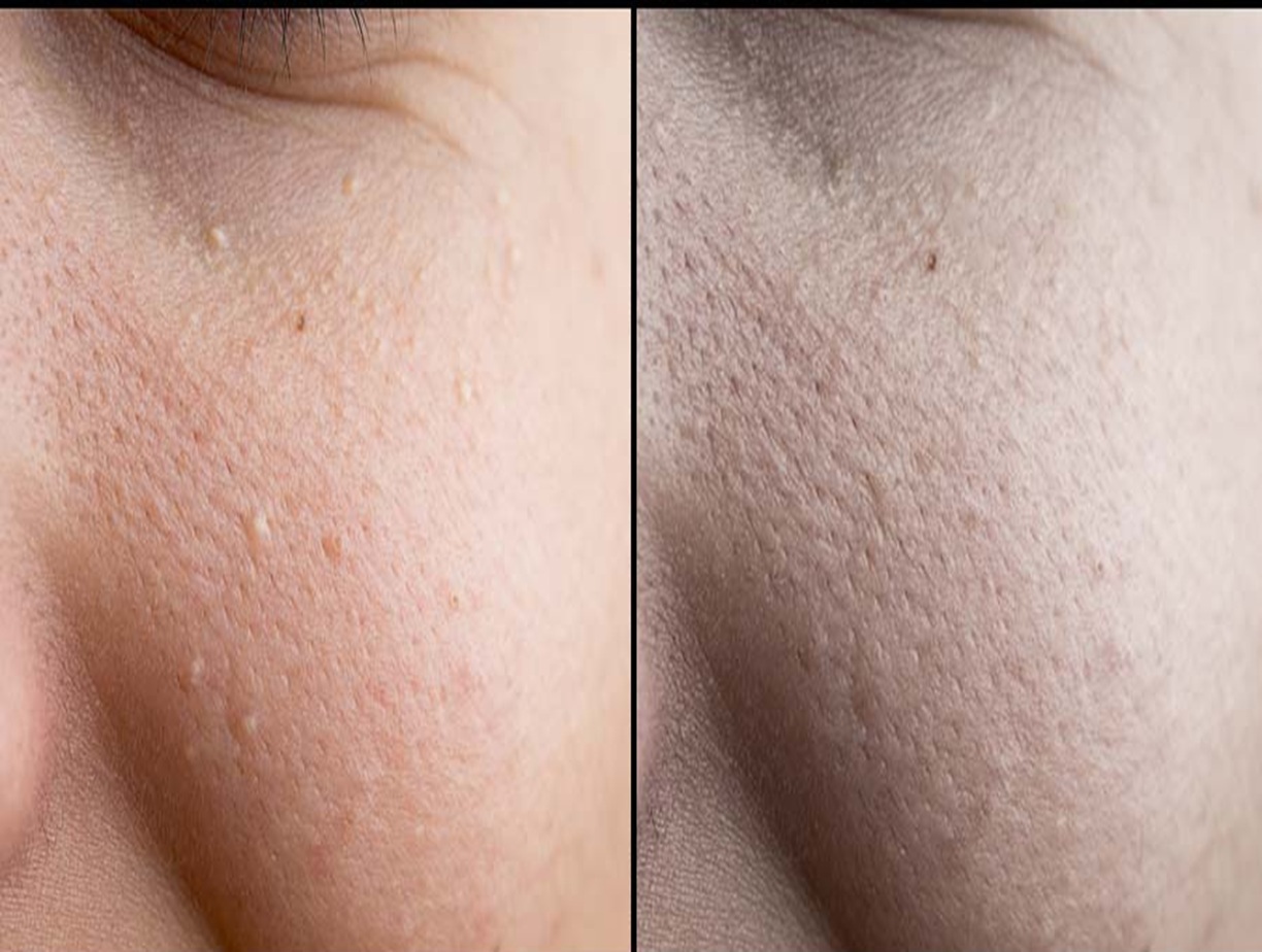 Before and after milia removal, Altrincham cosmetic skin clinic, Bollin Clinic