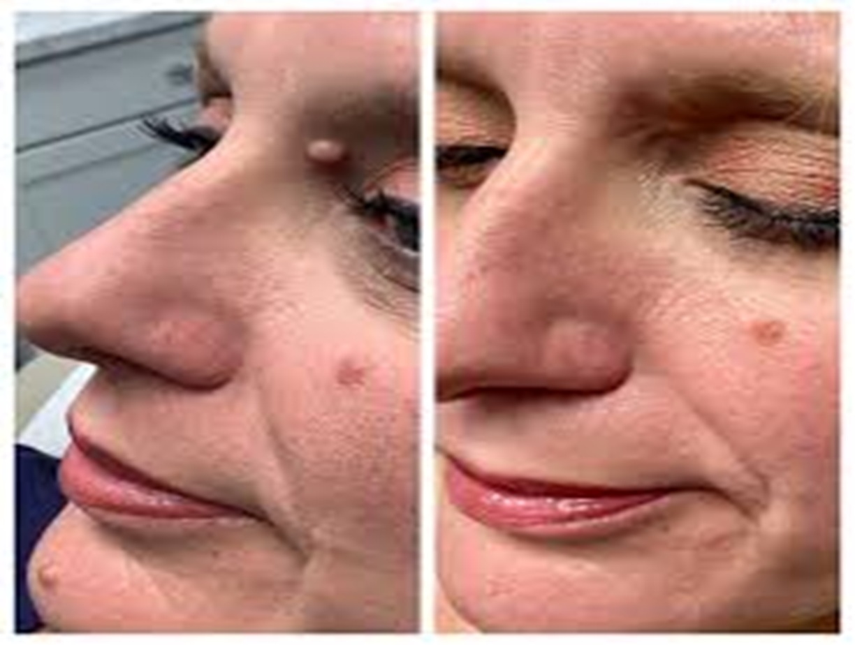 Mole removal before and after at Bollin Clinic, facial mole removal Altrincham, non-cancerous mole removal results
