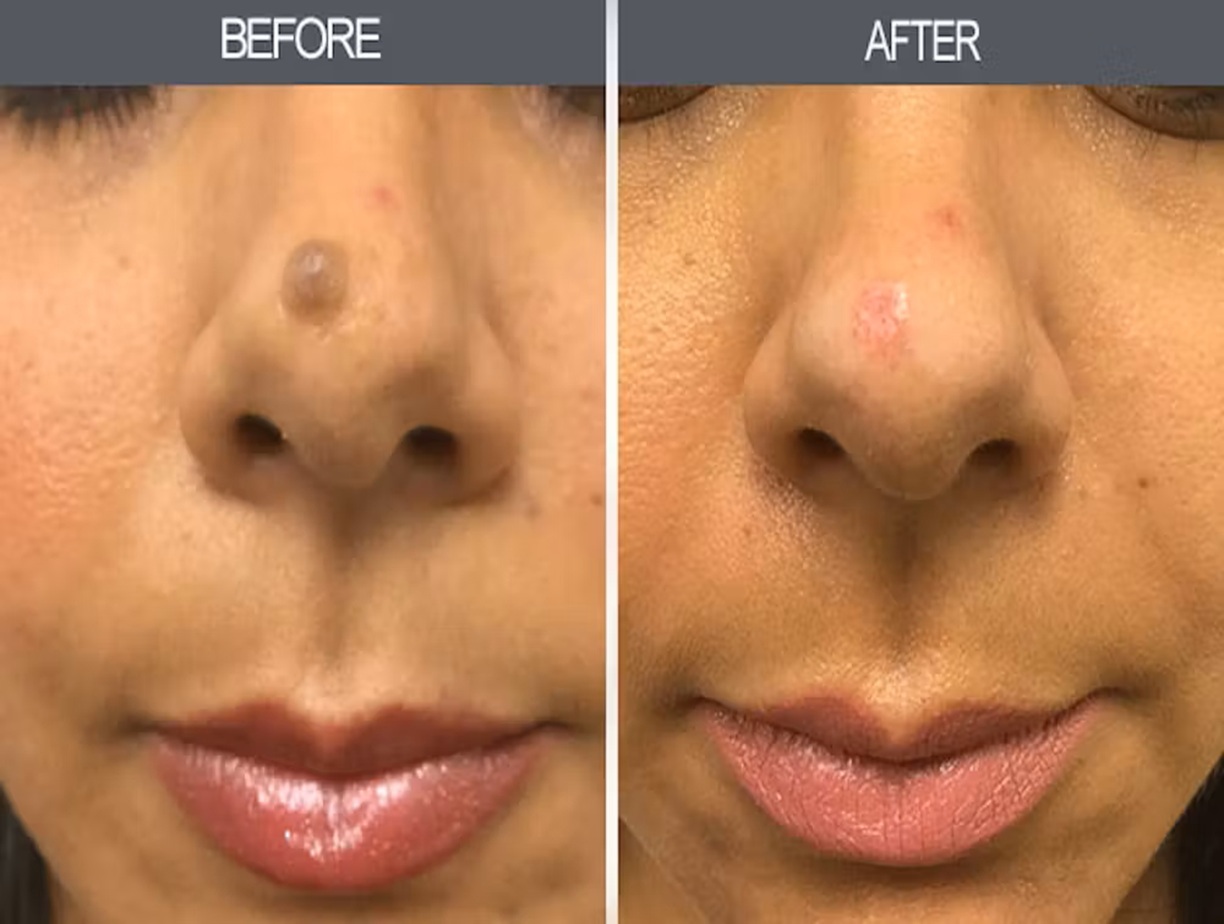 Cosmetic mole removal before and after, Bollin Clinic mole removal results, skin healing after mole removal