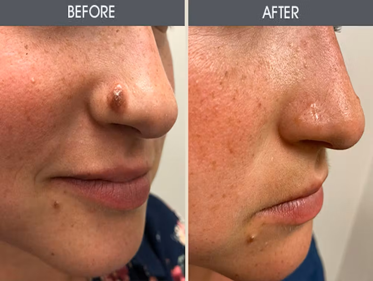Minimal scar mole removal Altrincham, expert skin tag removal, post-mole removal photos UK