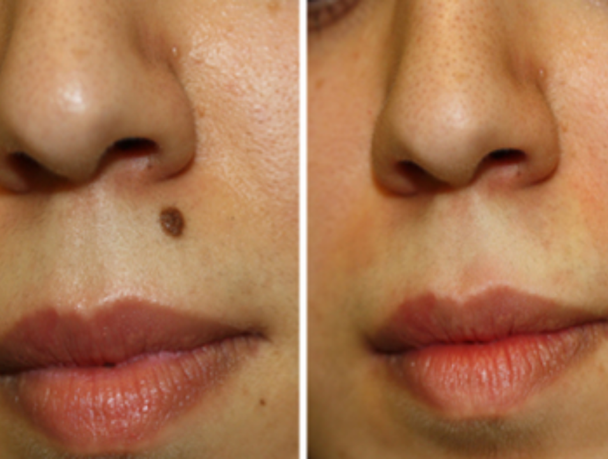 Minimal scar mole removal Altrincham, expert skin tag removal, post-mole removal photos UK