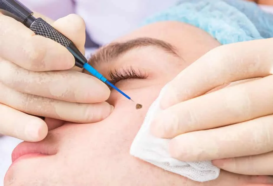 Best HydraFacial Treatment in Altrincham, UK