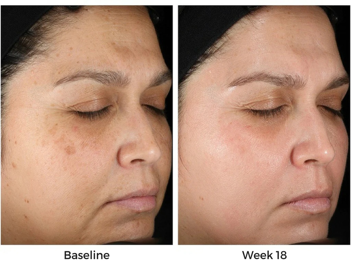 Obagi Skincare Altrincham, Bollin Clinic Obagi results, Obagi pigmentation treatment before and after, Obagi acne solution UK, Obagi Nu-Derm transformation, Obagi before and after skin photos