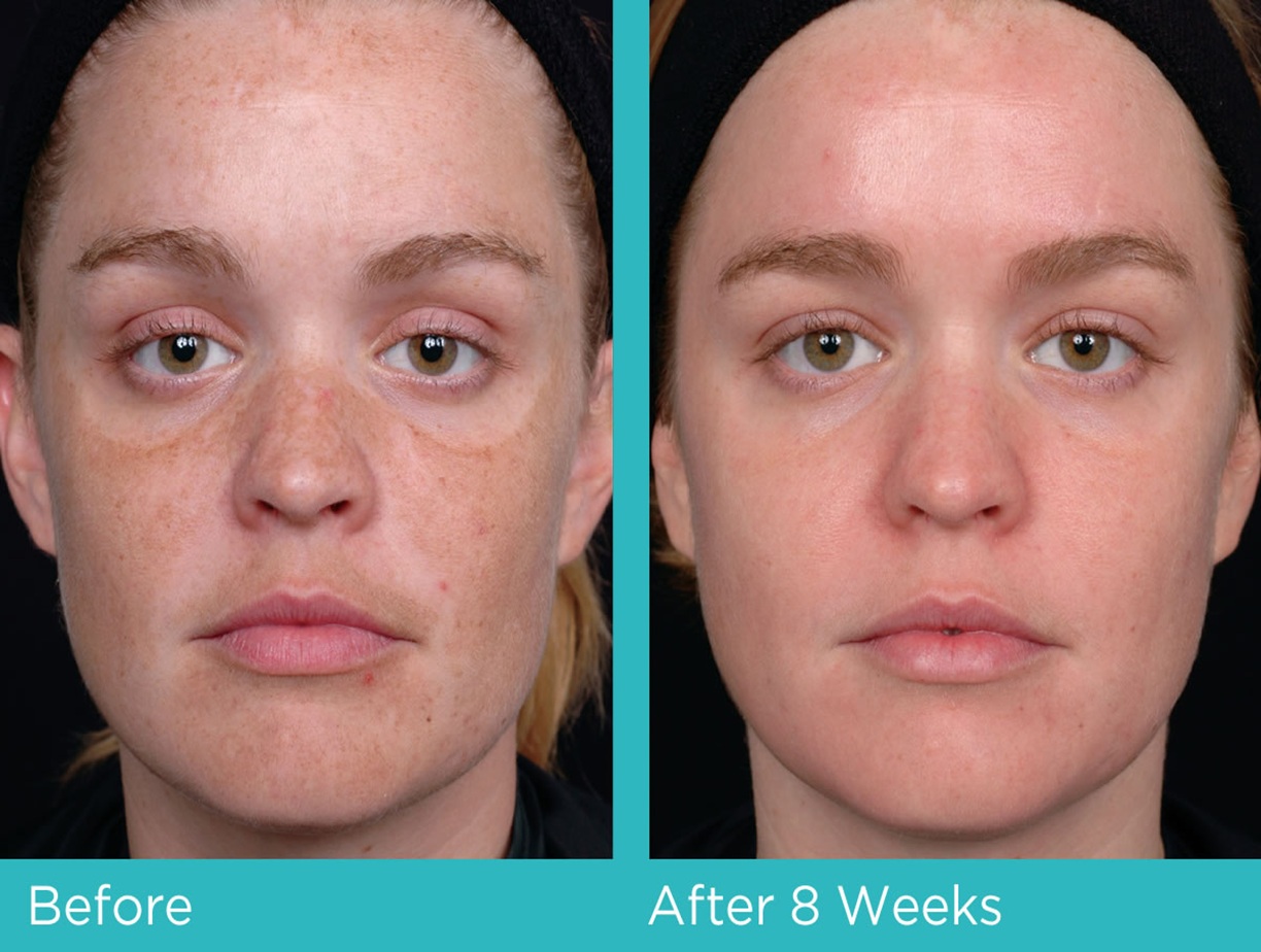 Obagi Skincare Altrincham, Bollin Clinic Obagi results, Obagi pigmentation treatment before and after, Obagi acne solution UK, Obagi Nu-Derm transformation, Obagi before and after skin photos