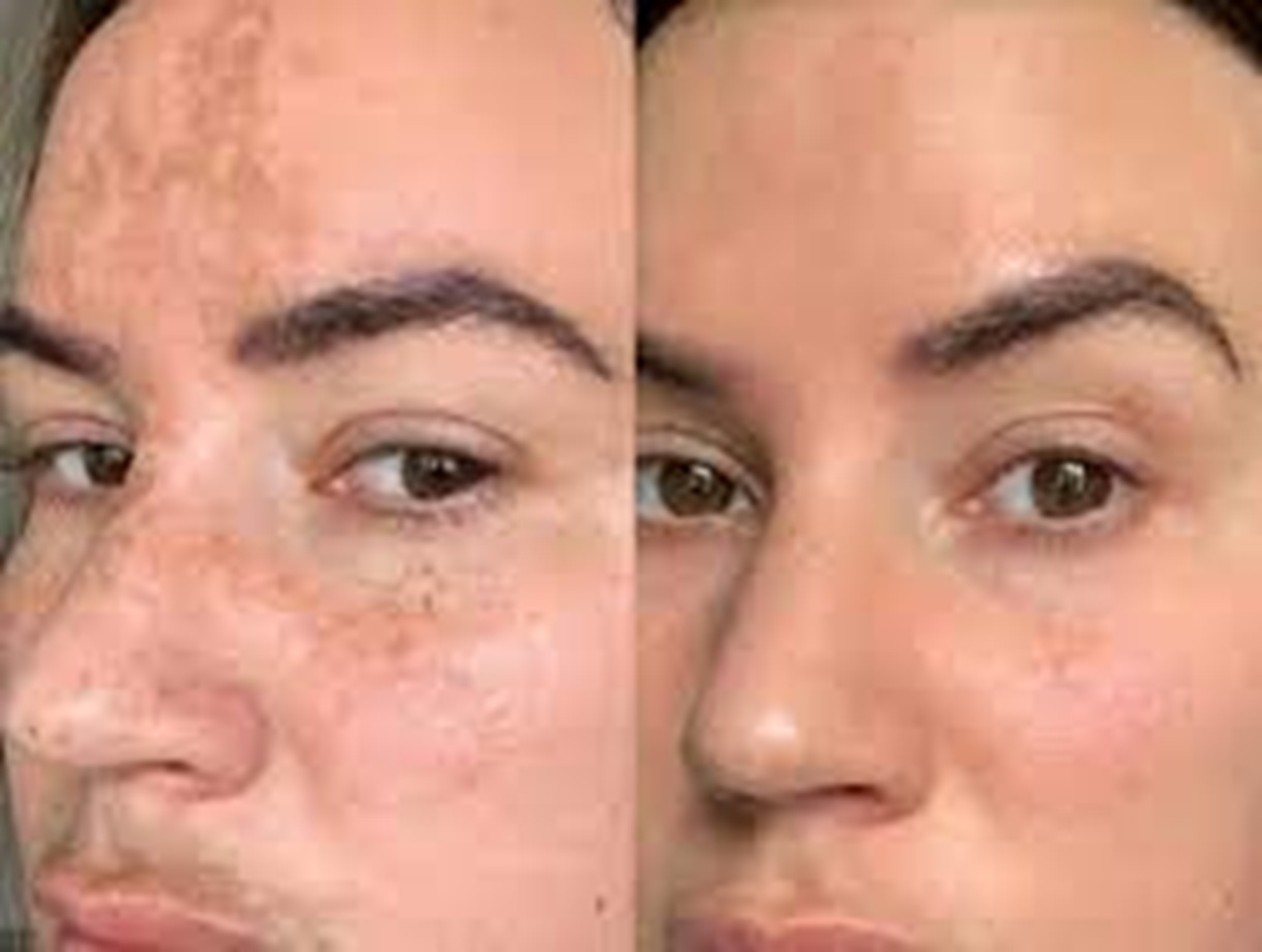 Obagi Skincare Altrincham, Bollin Clinic Obagi results, Obagi pigmentation treatment before and after, Obagi acne solution UK, Obagi Nu-Derm transformation, Obagi before and after skin photos