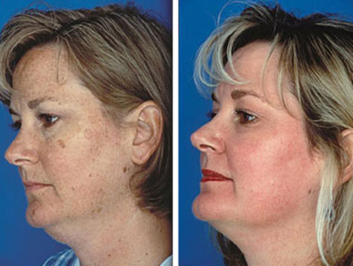 Obagi Skincare Altrincham, Bollin Clinic Obagi results, Obagi pigmentation treatment before and after, Obagi acne solution UK, Obagi Nu-Derm transformation, Obagi before and after skin photos