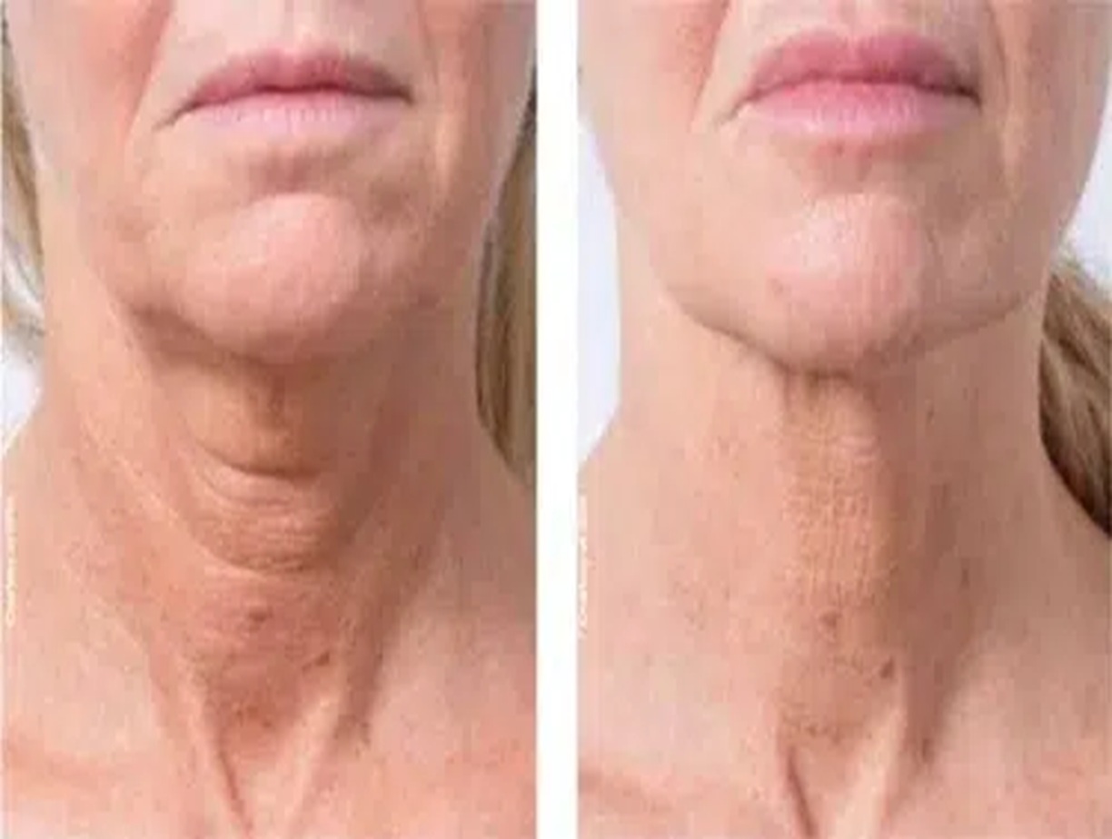 Profhilo Body Treatment Altrincham, Bollin Clinic, skin hydration, collagen stimulation, before and after, body skin tightening UK
