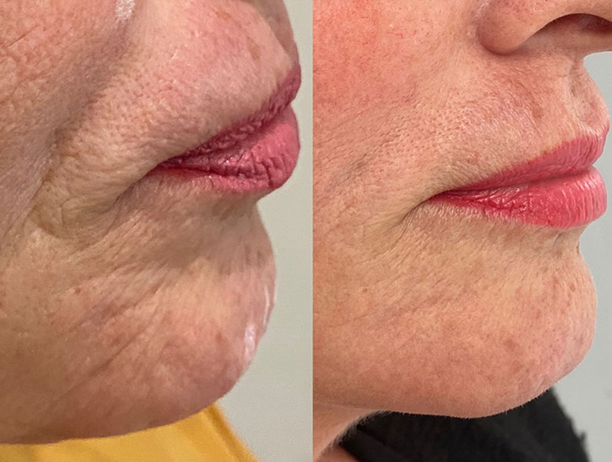 Profhilo Body Treatment Altrincham, Bollin Clinic, skin tightening, before and after, body rejuvenation UK