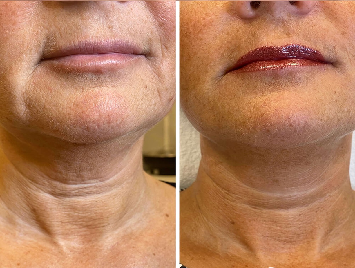 Profhilo Body Treatment Altrincham, Bollin Clinic, skin elasticity improvement, before and after photos UK