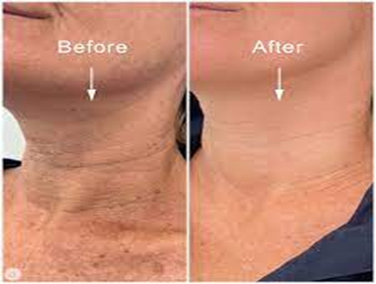 Profhilo Body Treatment Altrincham, Bollin Clinic, skin elasticity improvement, before and after photos UK